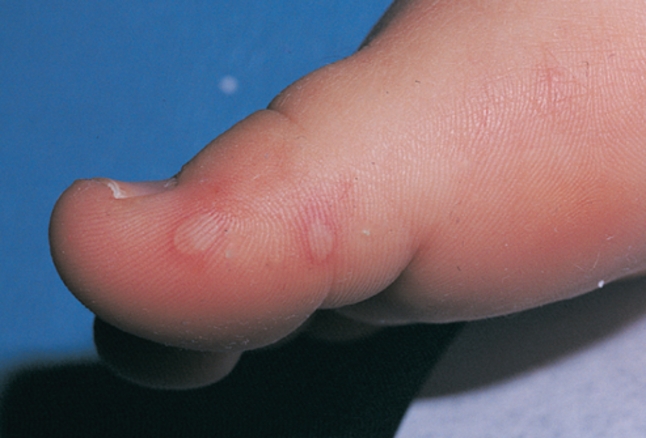 手足 口 病 かゆい 手足口病とは 知っておきたい 家庭の感染と予防 サラヤ株式会社 家庭用製品情報